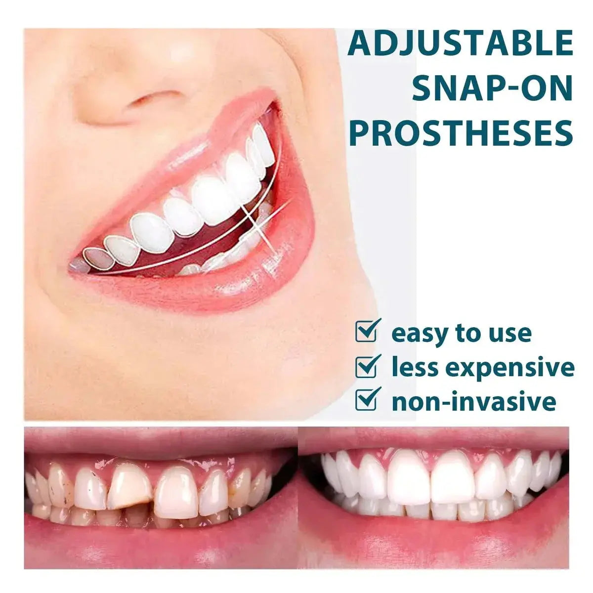 Adjustable Snap-On Dentures Pameza