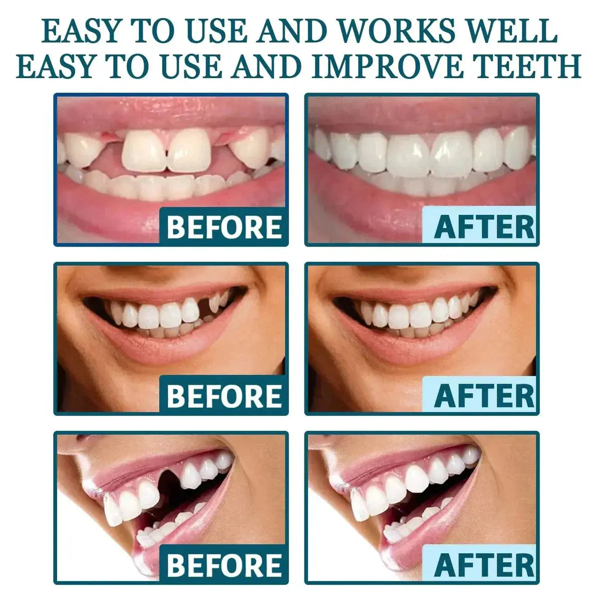 Adjustable Snap-On Dentures Pameza