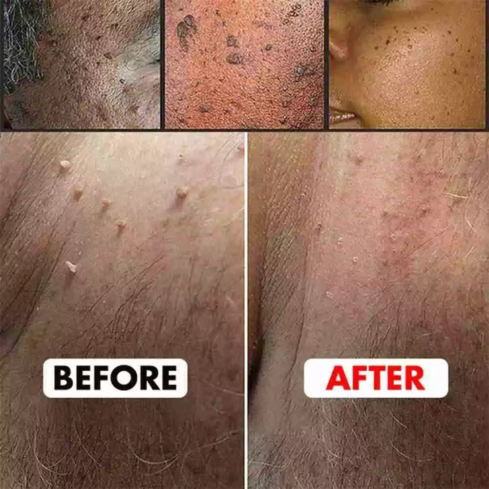 WartAway Herbal Removal Cream
