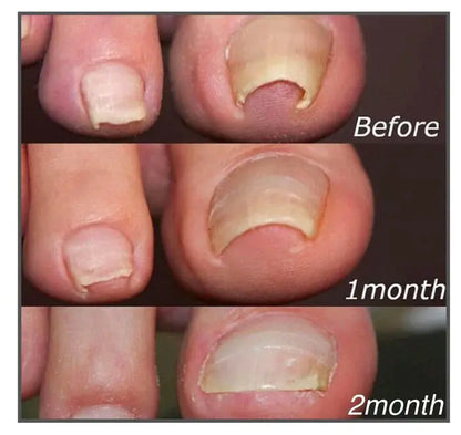 Correction patches for beautiful and healthy nails Pameza