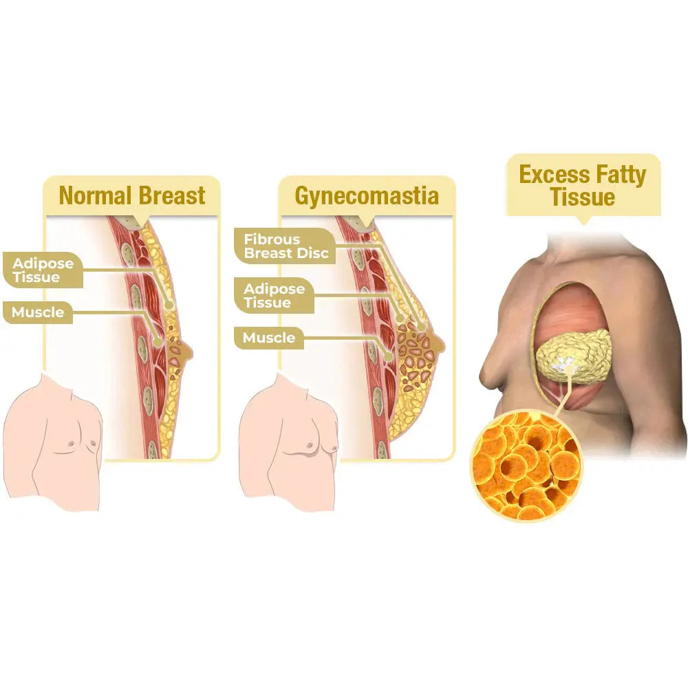 GFOUK™ MenTherm Bee Venom Gynecomastia Heating Oil Pameza