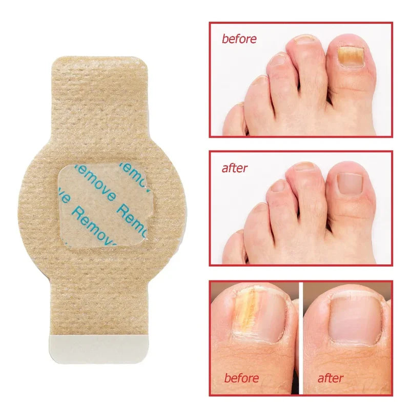 Fungal Nail Patches (21 Pcs)