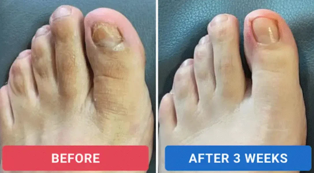 Fungal Nail Patches (21 Pcs)
