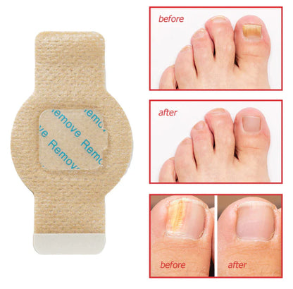Fungal Nail Patches (21 Pcs)