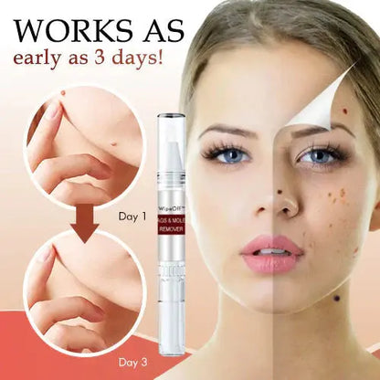 WIPEOFF™ TAGS & MOLES REMOVER Pameza
