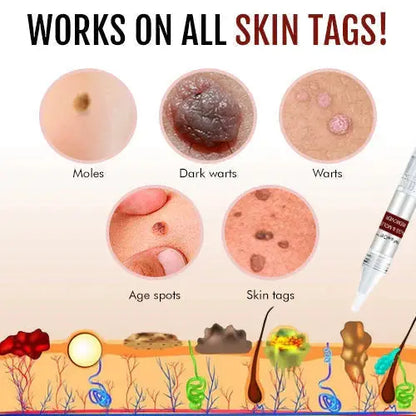 WIPEOFF™ TAGS & MOLES REMOVER Pameza