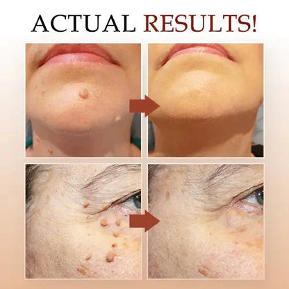WIPEOFF™ TAGS & MOLES REMOVER Pameza