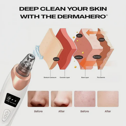 Blackhead Remover Facial Pore Vacuum